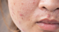 What causes high testosterone in women