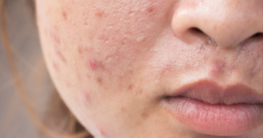 What causes high testosterone in women