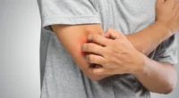Anxiety Rash