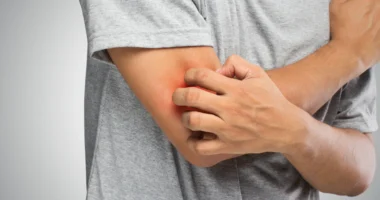 Anxiety Rash