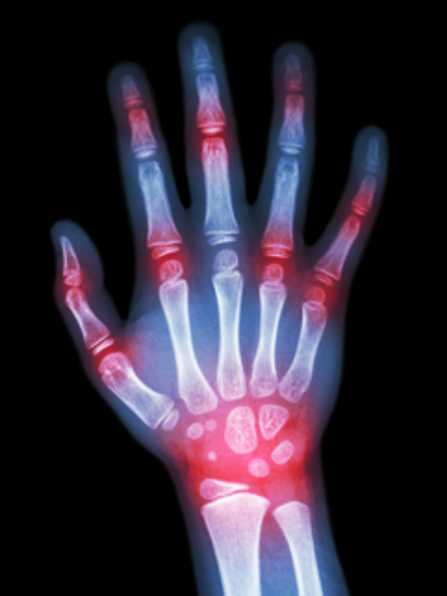 7 Myths About Gout